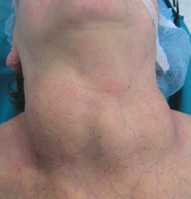 Chirurgia della tiroide